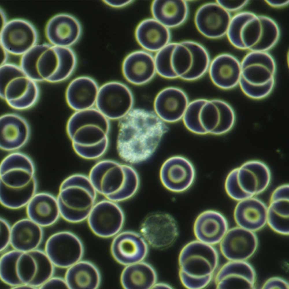 Live blood sample showingwhite blood cells before a session of PEMF therapy on CELLER8