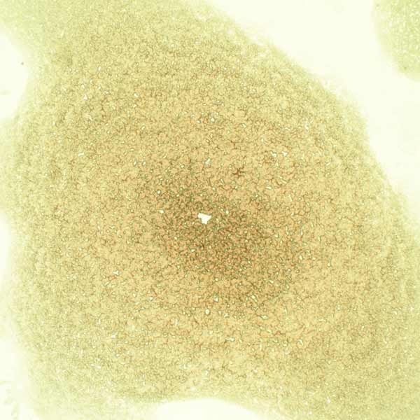 Dry blood sample showing inflammation after a session of PEMF therapy on CELLER8